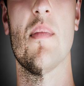 اهمیت لیزر موهای زائد برای مردان